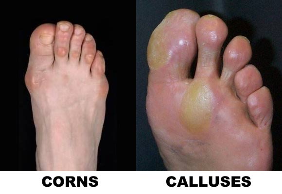 Podiatrist examining hard skin and a cracked heel