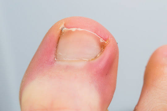 podiatrist treating ingrown toenail SE12