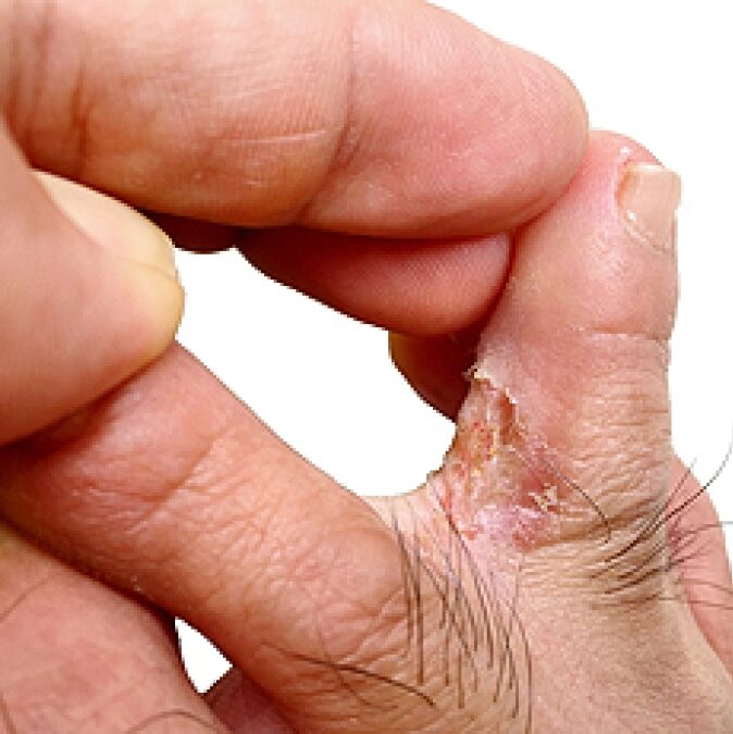 athlete's foot treatment SE12, lee green. hither green